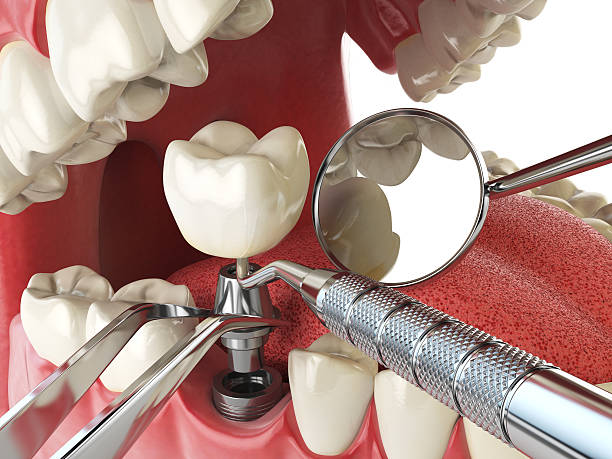 Best Emergency Dental Care for Broken or Chipped Teeth in Gurnee, IL